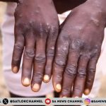 मंकीपॉक्स: भारत में  स्वास्थ्य आपातकाल घोषित