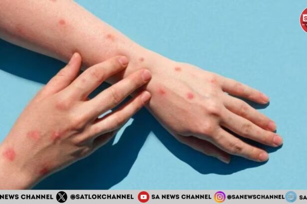 Monkeypox India Alert भारत में मंकीपॉक्स का अलर्ट जारी