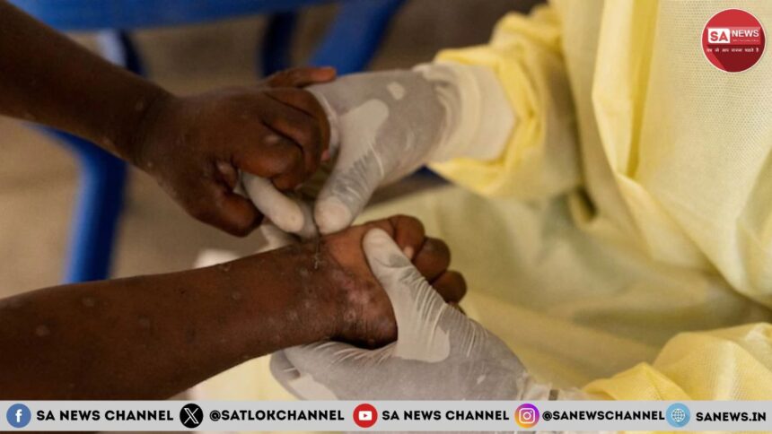 Breaking the Stigma Around Mpox Quick Facts You Should Know