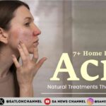 7+ Home Remedies for Acne Natural Treatments That Actually Work