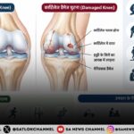कार्टिलेज डैमेज के शुरुआती लक्षण, कारण और बचाव