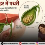 गॉल ब्लैडर की पथरी लक्षण, कारण, जांच, इलाज और बचाव के उपाय